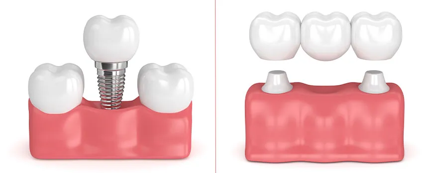 Implantát vs můstek